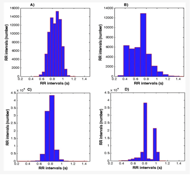 Histogram RR – przykłady różnych stanów